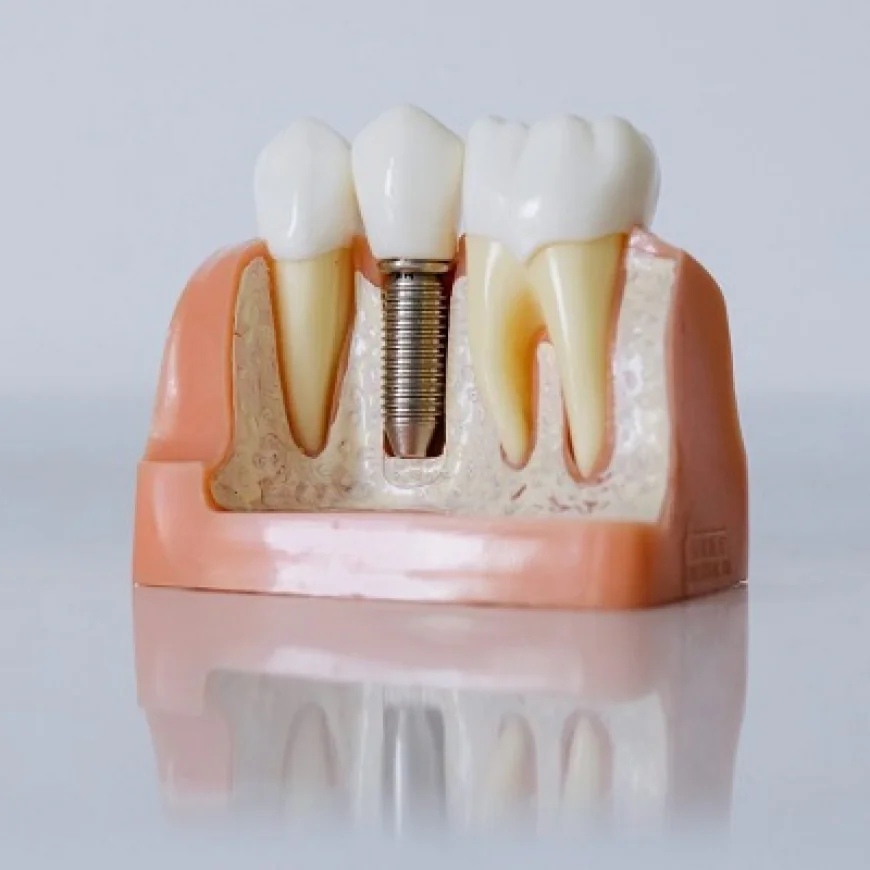 Dental Implants to Regain Your Confident Smile