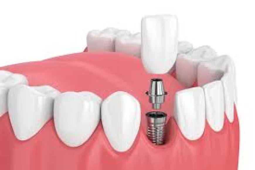 Root Canal Treatment Cost: What You Need to Know Before Sitting in the Chair