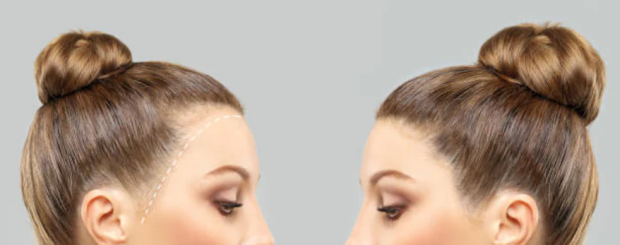 تجربة زراعة الشعر في الرياض من الألف إلى الياء