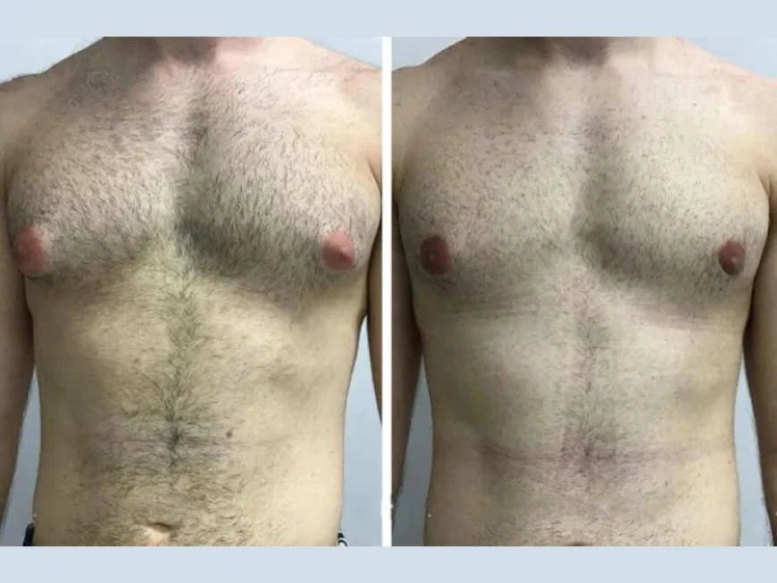 Recovery Tips After Surgery from the Best Gynecomastia Surgeon in Dubai