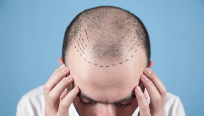 How To Choose The Right Hair Transplant Clinic Today?
