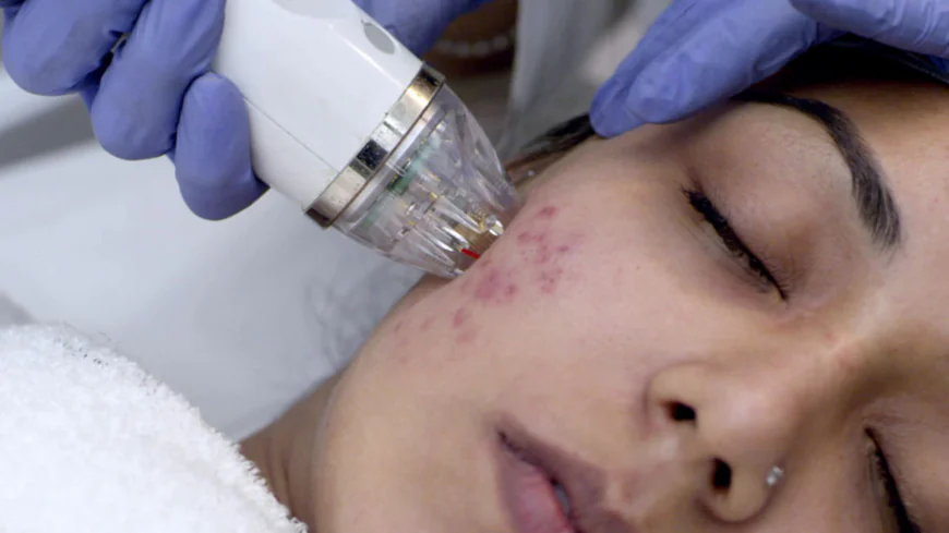 IPL vs. Laser for Acne Scars: Understanding the Difference