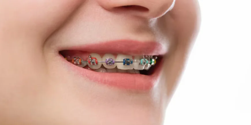 How Modern Orthodontics Is Reshaping Everyday Smile Confidence