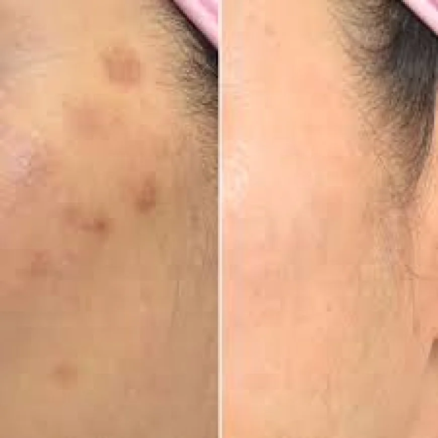 Rejuvenate Your Skin with Pico Laser Treatment in Islamabad