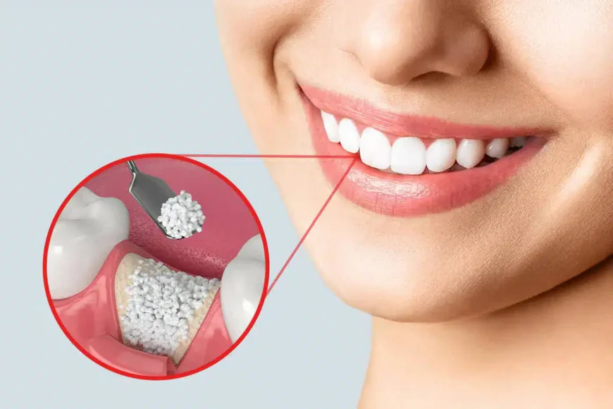Rebuilding Smiles with Confidence: Understanding Bone Grafting in Louisville