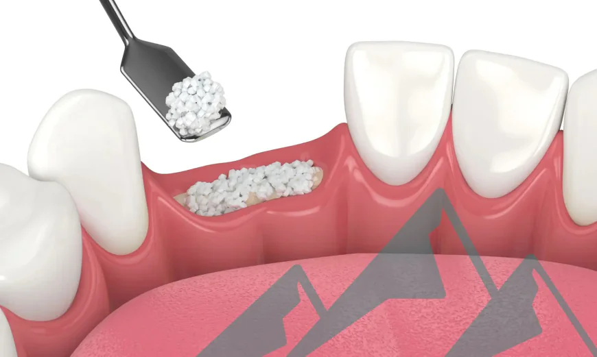 Rebuilding Smiles with Confidence: Understanding Bone Grafting in Louisville