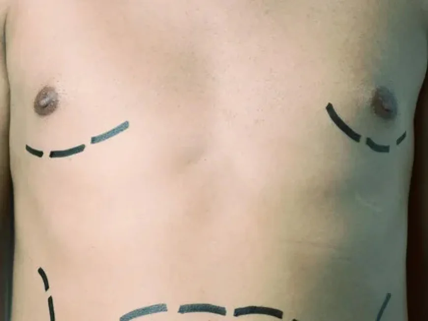 How Effective is Liposuction for Gynecomastia in Riyadh?
