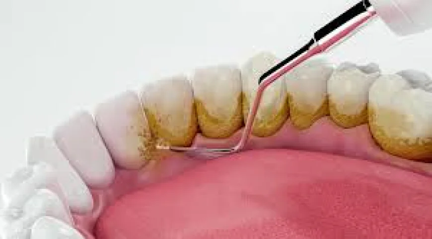 Smile Brighter: Expert Guide to Teeth Scaling Services in Islamabad