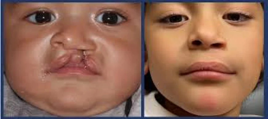 Cleft Lip and Palate Treatment in Islamabad: What You Need to Know