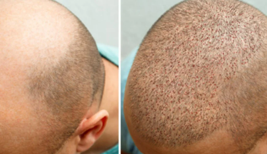 Advanced Hair Treatment in Islamabad for Lasting Results