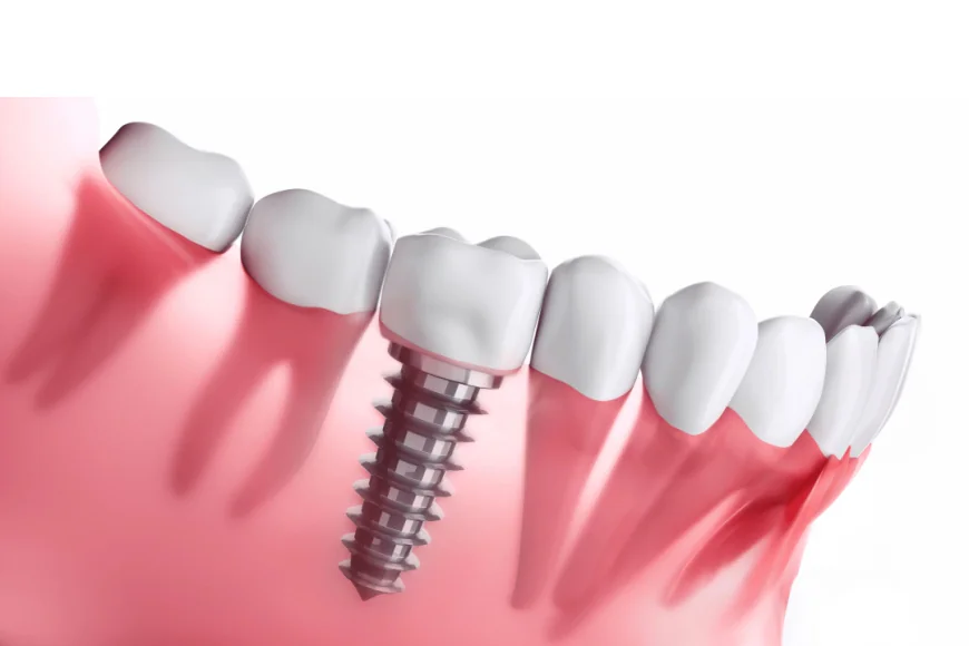 Restore Your Smile with Advanced Dental Implants in Nashville