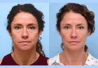 Improve Facial Contours Naturally With Expert-Performed Thread Lift in Dubai Procedures