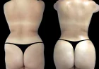 Hyacorp Fillers Treatments in Dubai Long-Lasting Volume & Shape