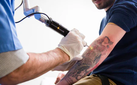 What is tattoo removal and how does it work?