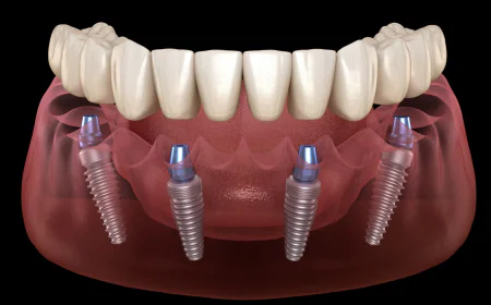 Regain Your Confident Smile with All-on-4 Dental Implants in Vancouver
