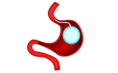 Gastric Balloon and Daily Health