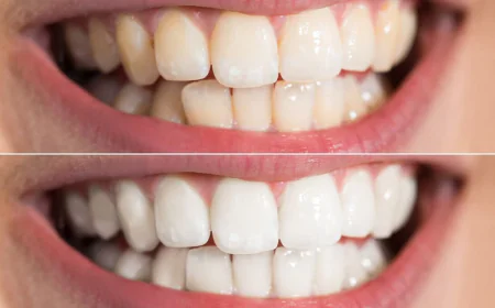 Why Are Professional Teeth Whitening Treatments More Effective?