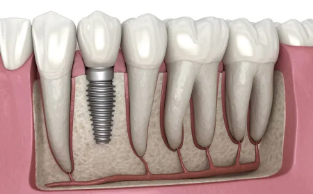 Say Goodbye to Missing Teeth with Dental Implants