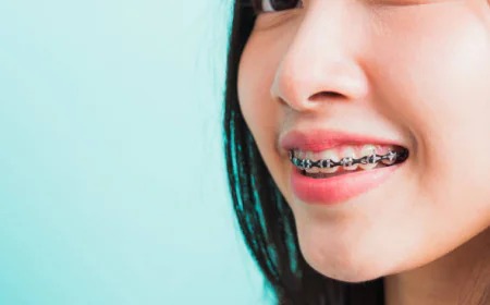 Why Metal Braces in Tracy Are Still a Trusted Orthodontic Solution