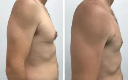 Understanding Gynecomastia Surgery in Dubai: Step-by-Step