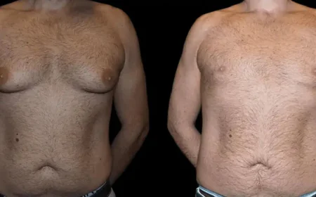Gynecomastia for Overweight Patients in Dubai