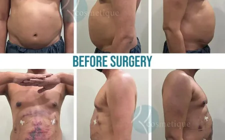 Why Choosing the Right Liposuction Clinic Matters