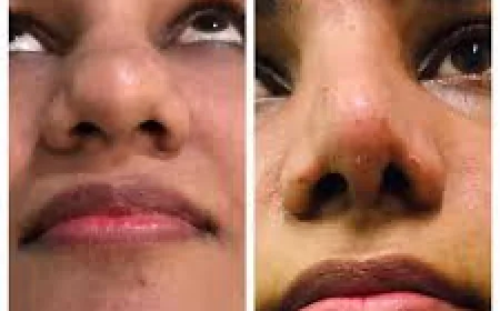 Is Rhinoplasty Cost in Pakistan Affordable? A Detailed Look