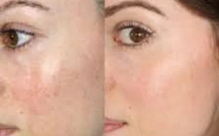 Microneedling Treatment in Islamabad – The Secret to Flawless Skin