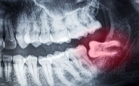 Panoramic X-Ray for Tooth Implant Planning