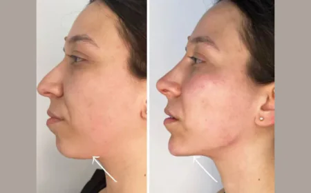 Achieve Timeless Beauty with Endolift from the Best Plastic Surgeons in Dubai