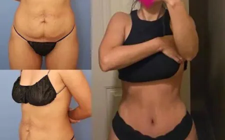 Tummy Tuck Recovery in Dubai: What You Should Know for a Smooth Healing Process