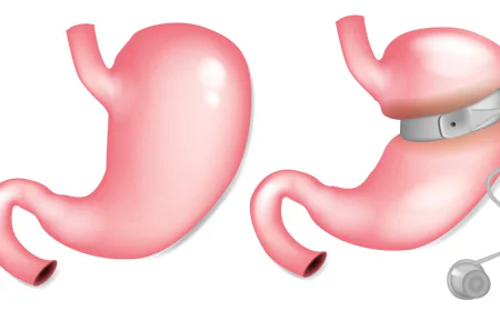 What Is Gastric Balloon Placement?