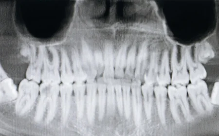 Is Panoramic Dental X-Ray cost Expensive?