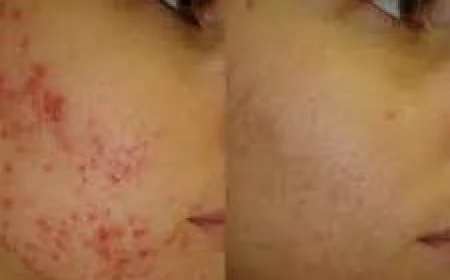 Acne Scars Treatment in Islamabad – A Step Toward Flawless Skin