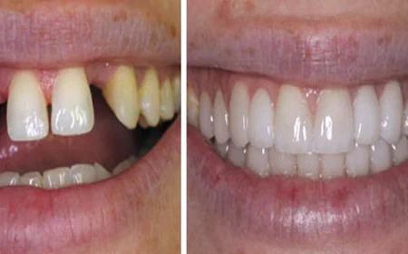 A Complete Guide to Restoring Oral Health