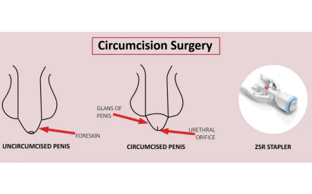 Circumcision Surgery in Mumbai: Benefits, Risks, and Recovery