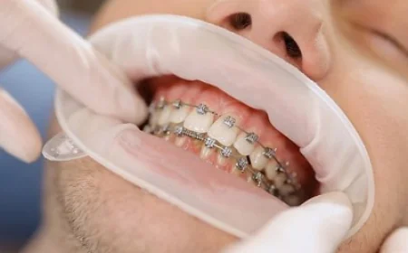 Orthodontists’ Guide to Retainers and Care