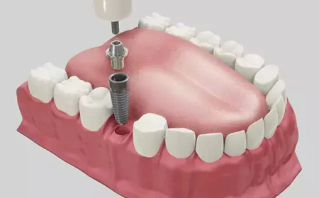 How Much Does a Single Tooth Implant Cost in Delhi?