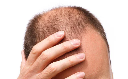 زراعة الشعر في الرياض.. تجربتي الشخصية مع أفضل مركز