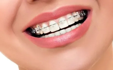 Invisible Teeth Braces vs Visible Braces: Insights