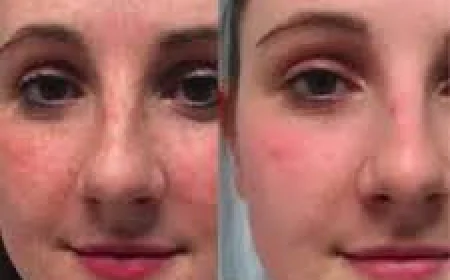 Effective Melasma Treatment Solutions Available in Islamabad