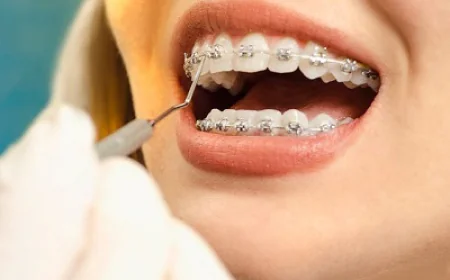 Braces for Kids: Metal vs Clear Options