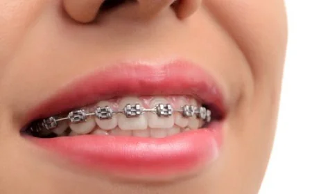 How Long Do Teeth Braces Take to Show Results?