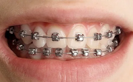 Cleaning Teeth Braces: Step-by-Step Oral Care Guide