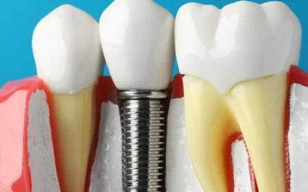 Dental Implants: A Complete Beginner’s Guide