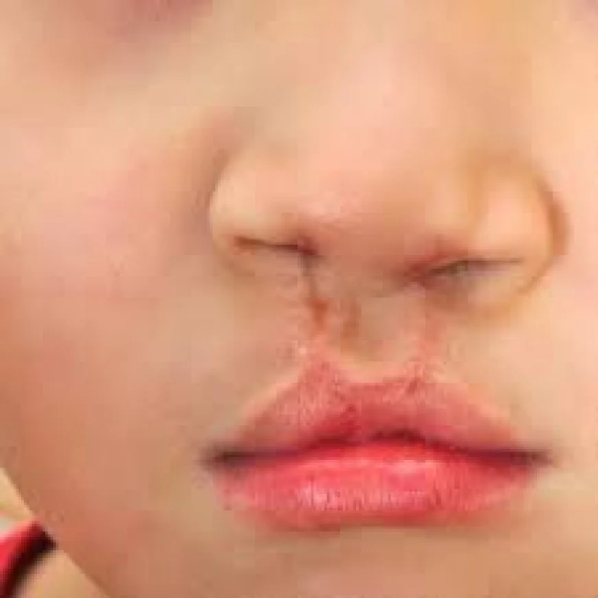 Comprehensive Guide to Cleft Lip and Palate Treatment in Islamabad
