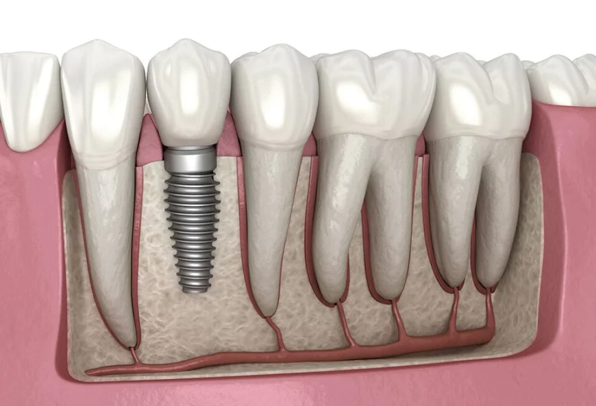 Restore Your Smile with Dental Implants in Camarillo