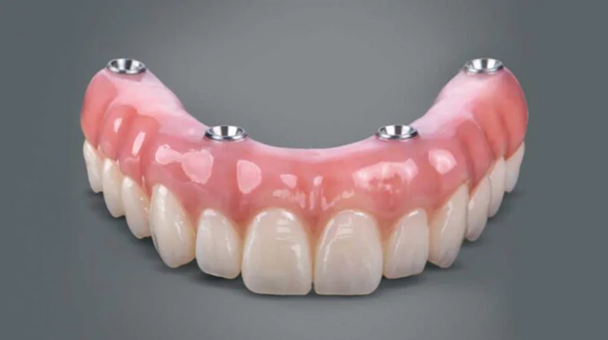 Restore Your Smile with All-on-4 Dental Implants in Chula Vista