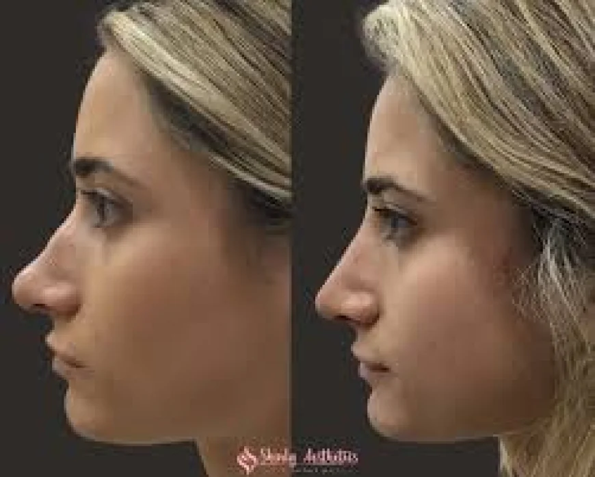 Everything You Need to Know About Nonsurgical Rhinoplasty in Islamabad