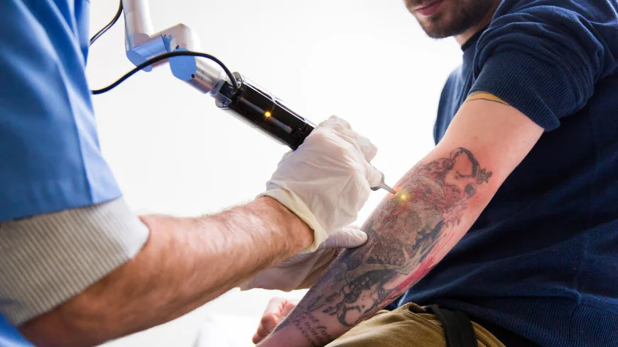 What is tattoo removal and how does it work?